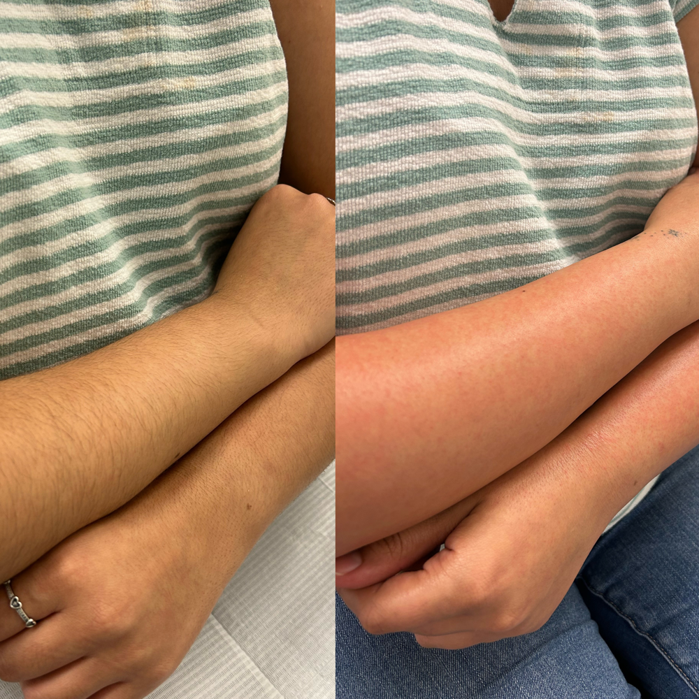Full Arm