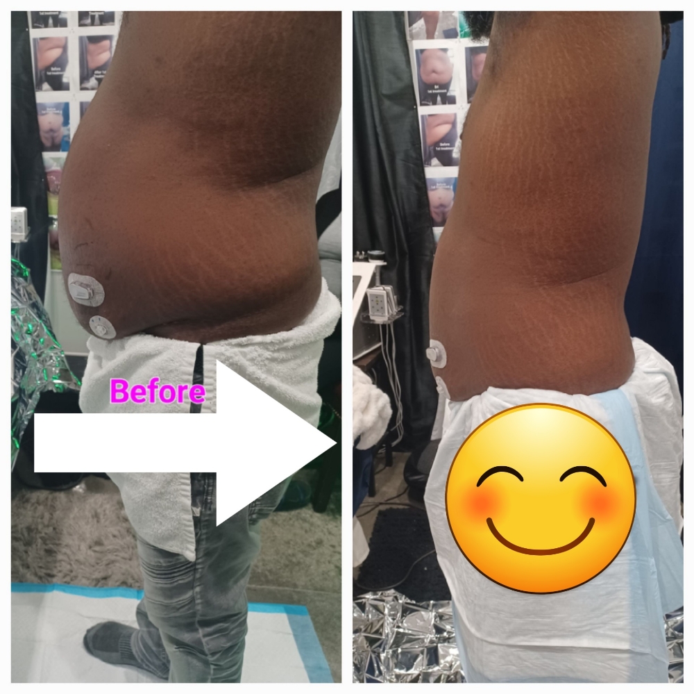 8 Session 💜 Stomac Lipo Cavitation