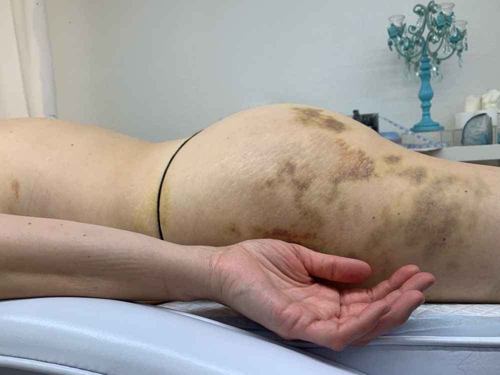 Post Op Lymphatic Drain Massage