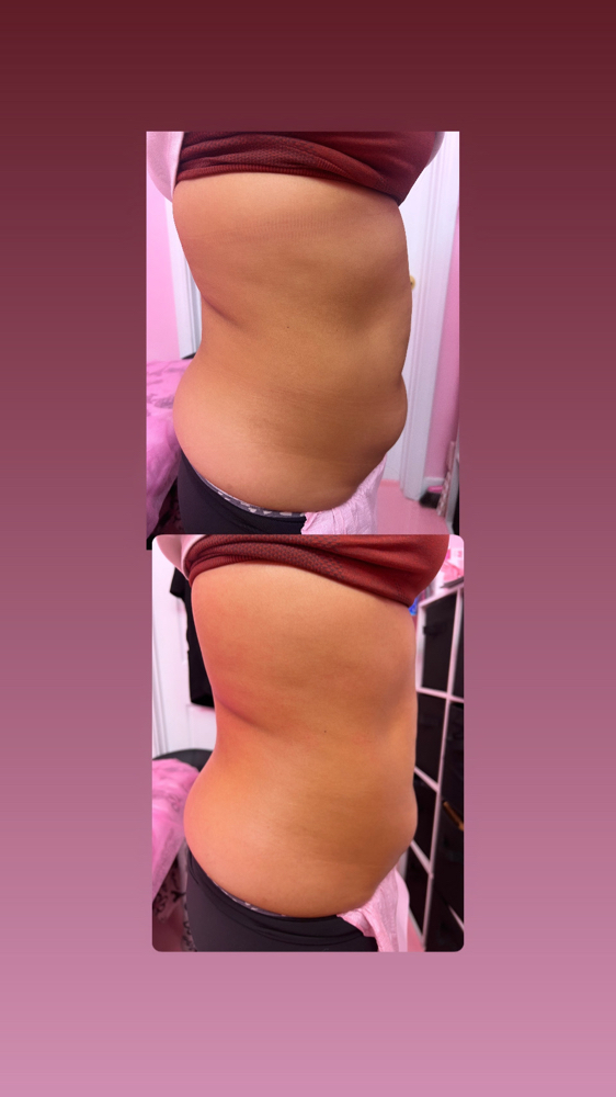 Lymphatic Massage + Radio Frequency