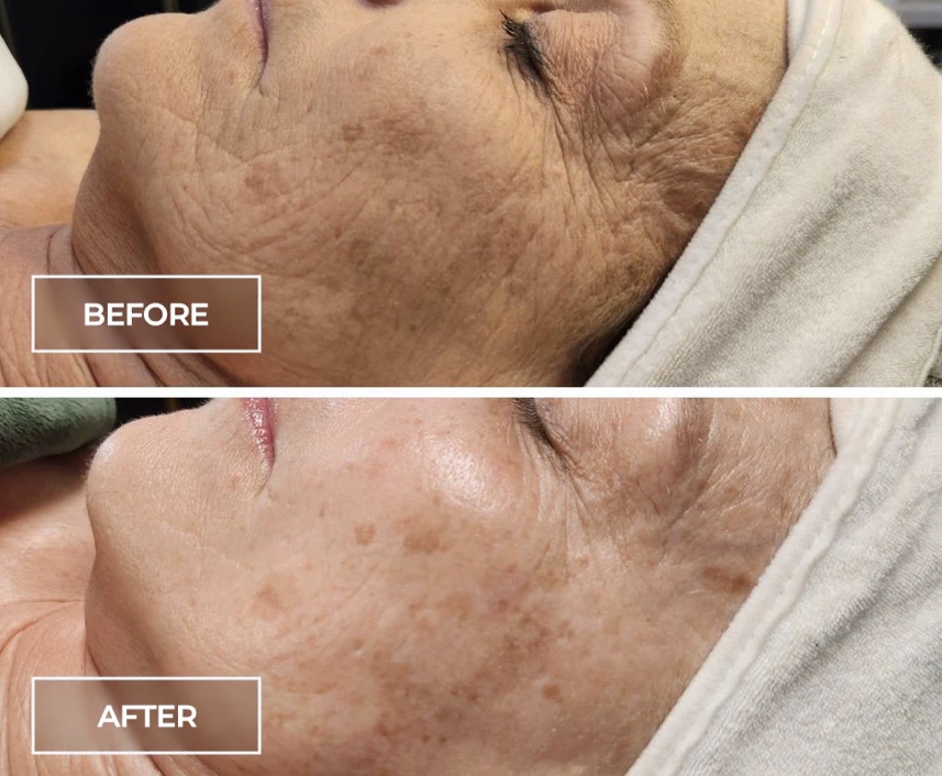 SWiCH Treatment