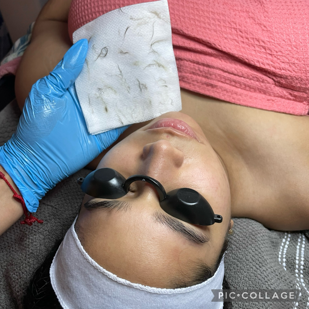 Dermaplanning
