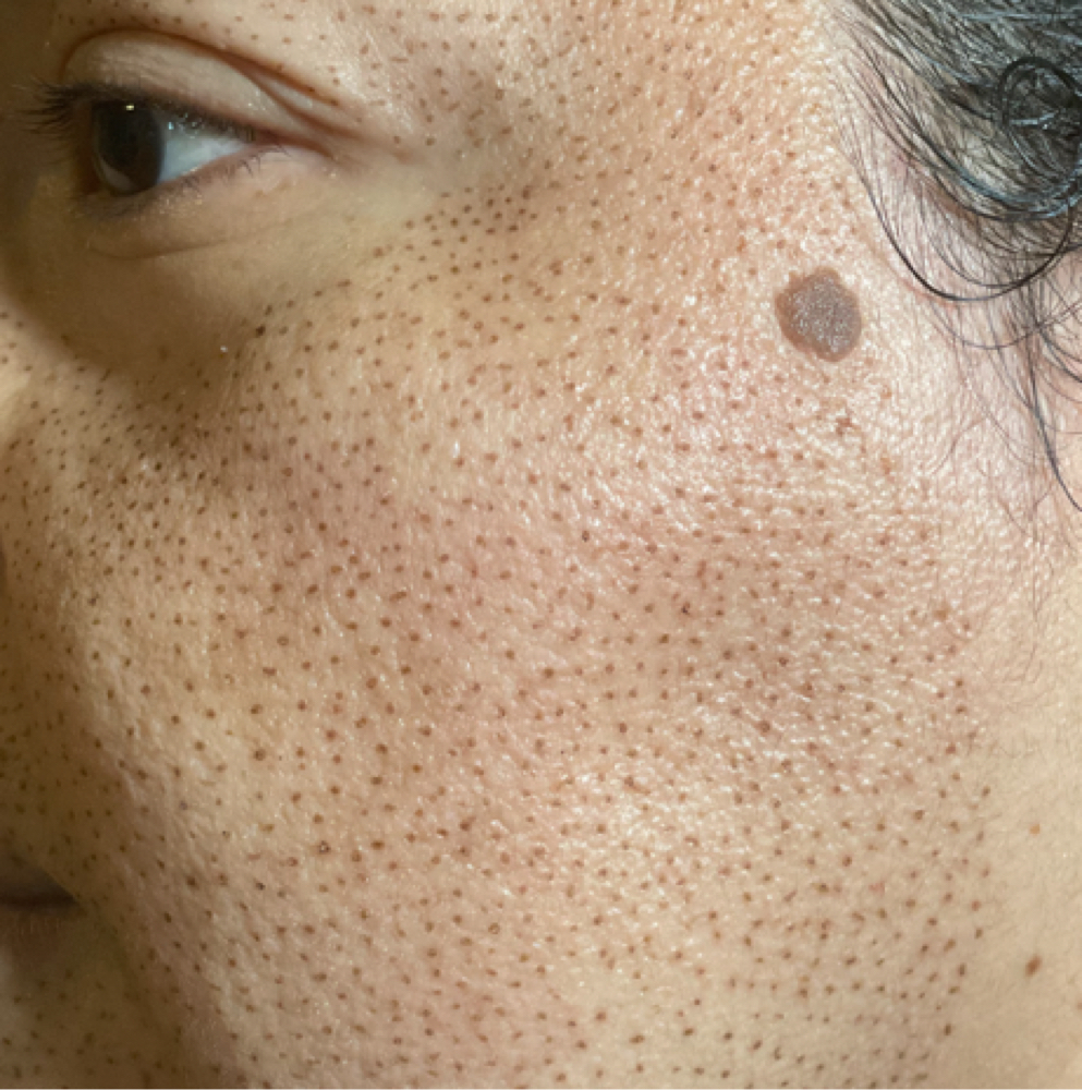 Fibroblast at Luxury Lash & Skincare in Norwood, MA