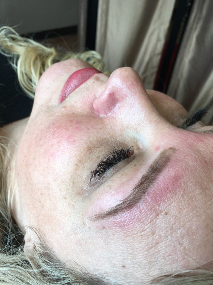 Brow With Lip Or Chin