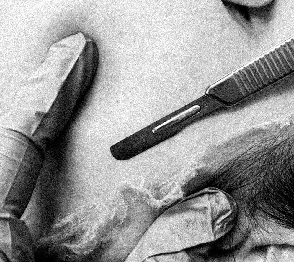 ADD ON • Dermaplane