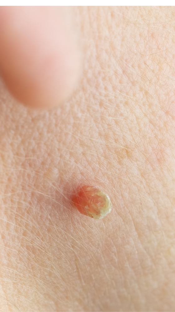 SKIN TAG REMOVAL