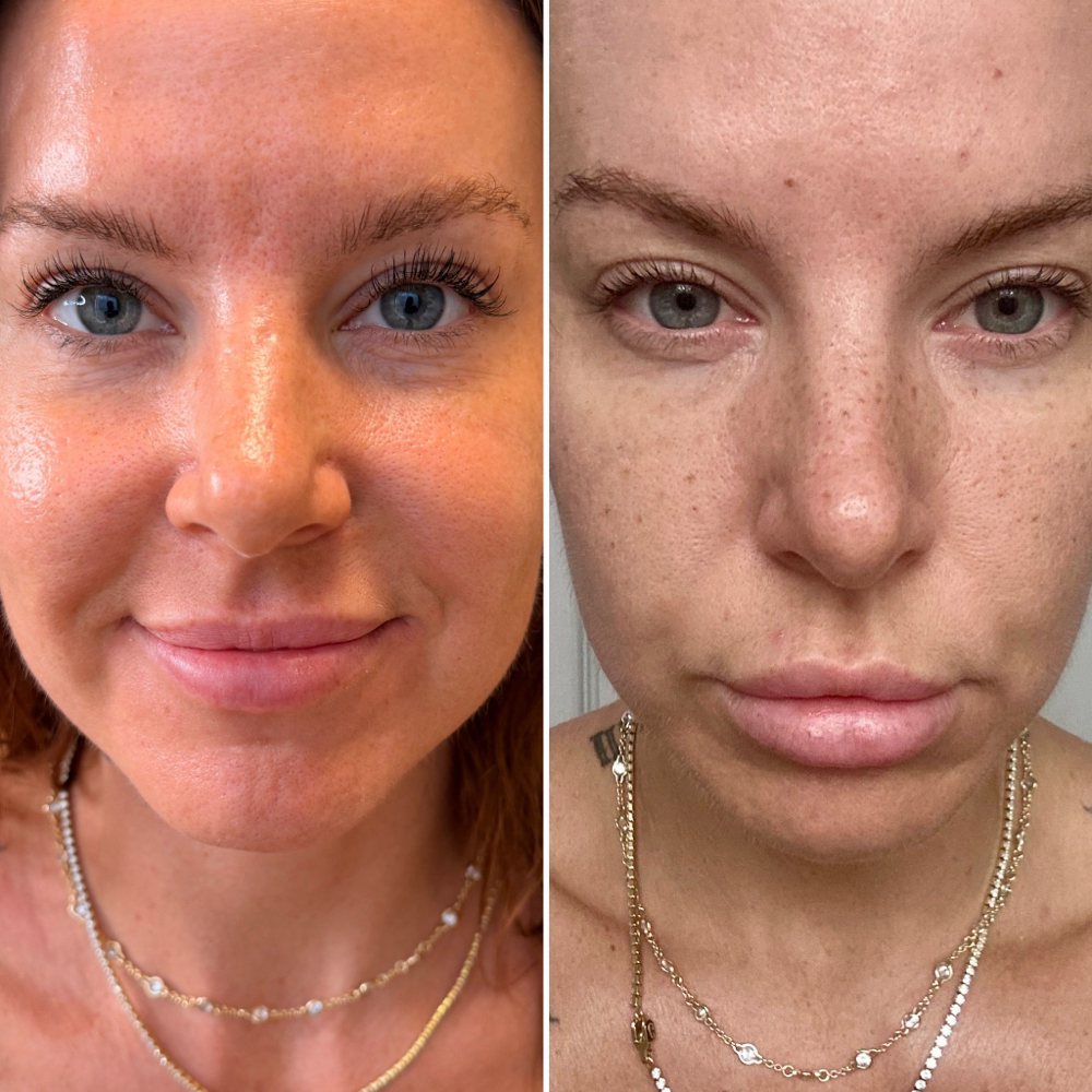 Faux Freckles at Skin Theory Collective in Port Richey, FL