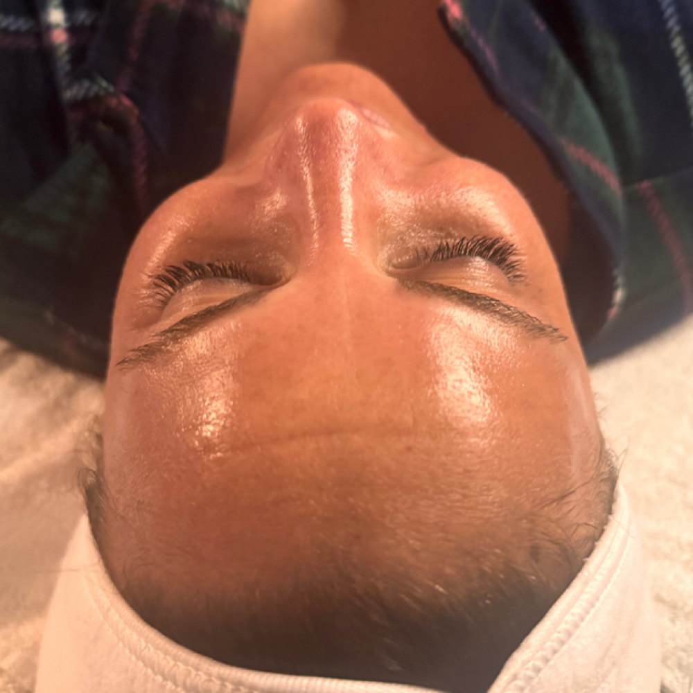 Chemical Peel at Golden Glow Esthetics in Lees Summit, MO