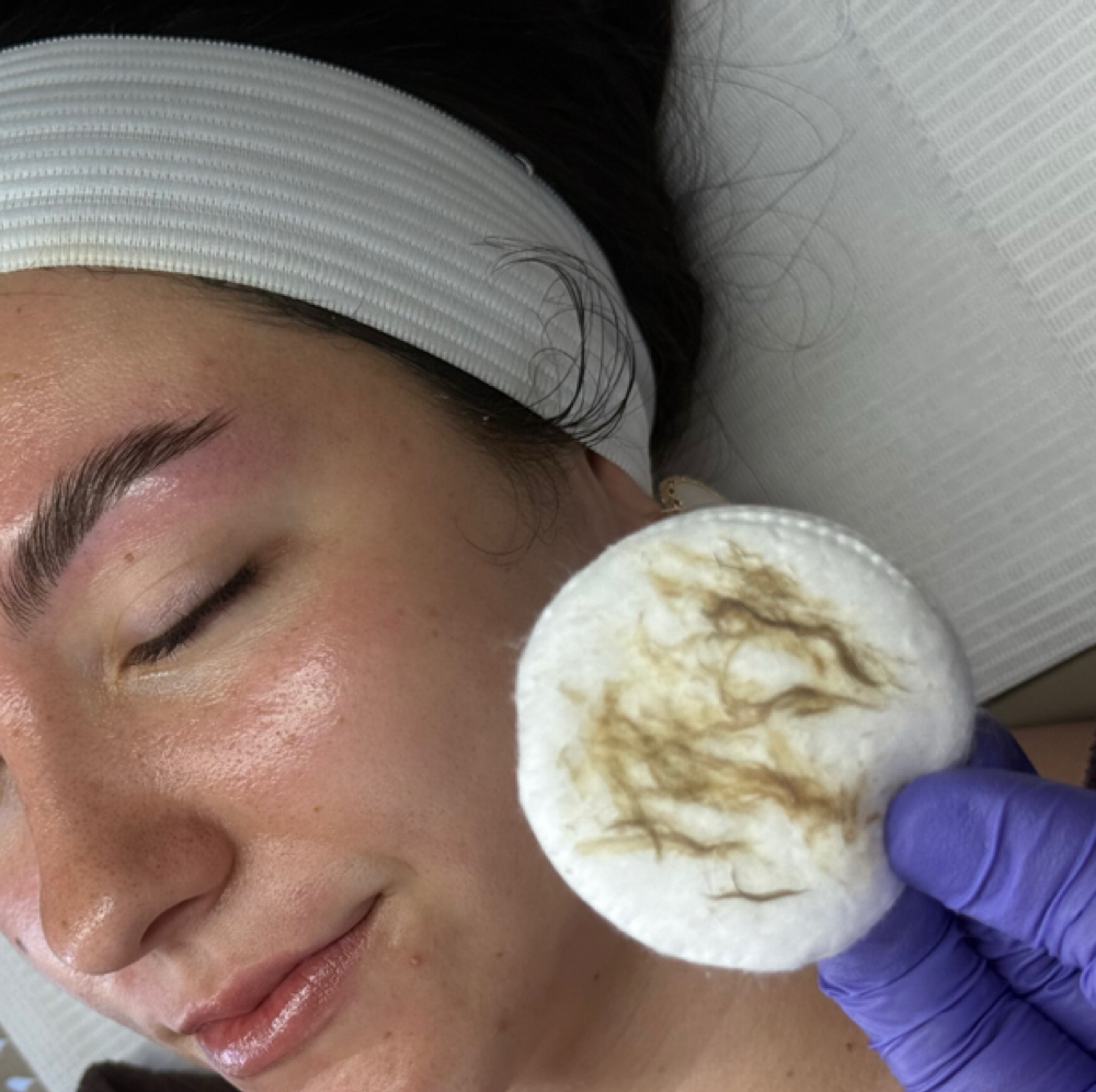 Dermaplane Treatment at Allure in Colonie, NY
