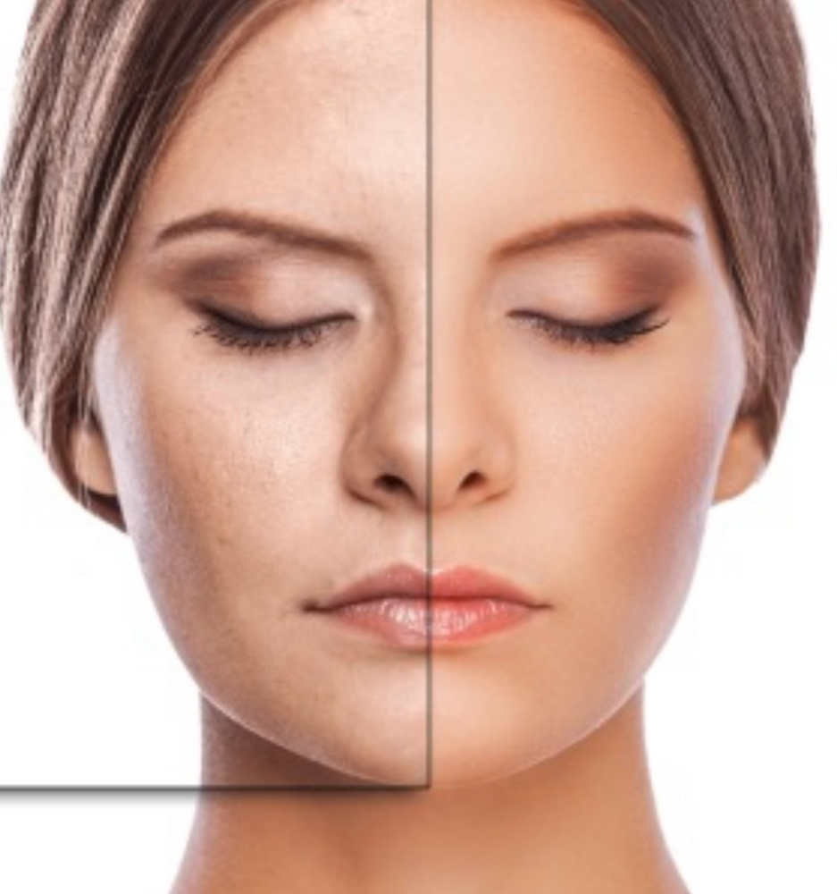Discoloration Treatment Injection
