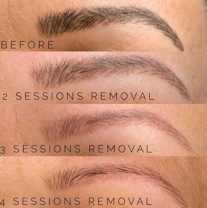 PMU Brow Removal