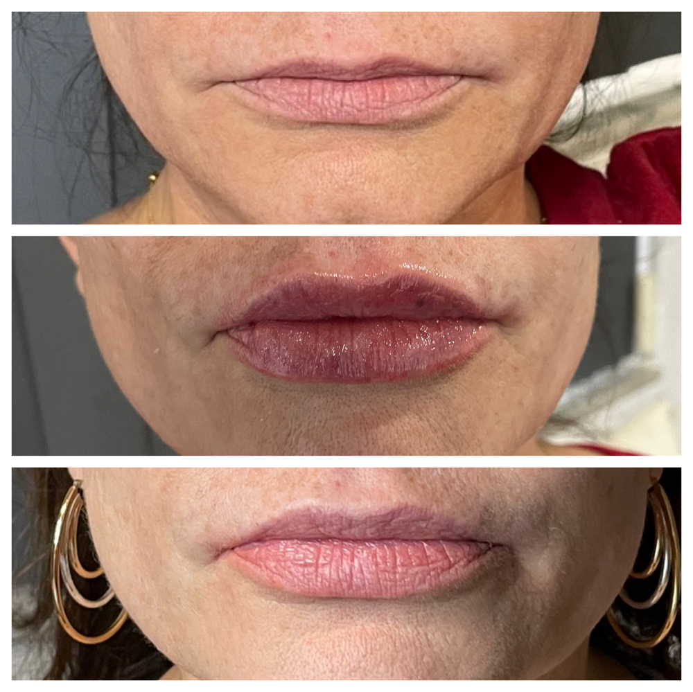 Needle-less Lip Filler