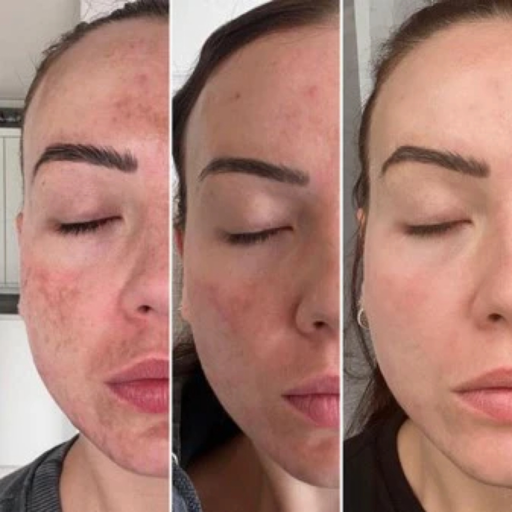 Chemical Peel at Charismatic Beauty in Apple Valley, CA