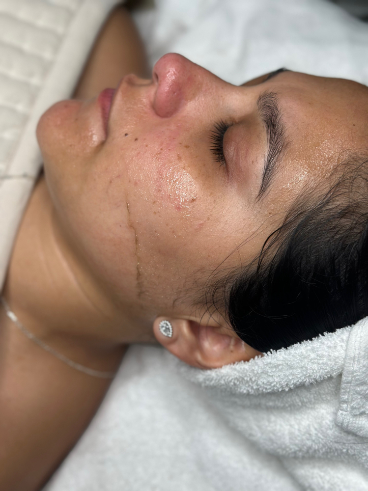𝐃𝐞𝐫𝐦𝐚𝐩𝐥𝐚𝐧𝐞 𝐅𝐚𝐜𝐢𝐚𝐥 at Home Glam Esthetics in Cicero, IL