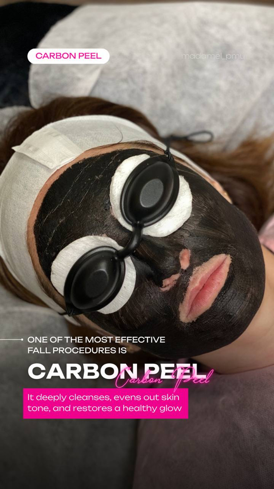 Carbon Peel at Madame L Beauty Studio in Downers Grove, IL