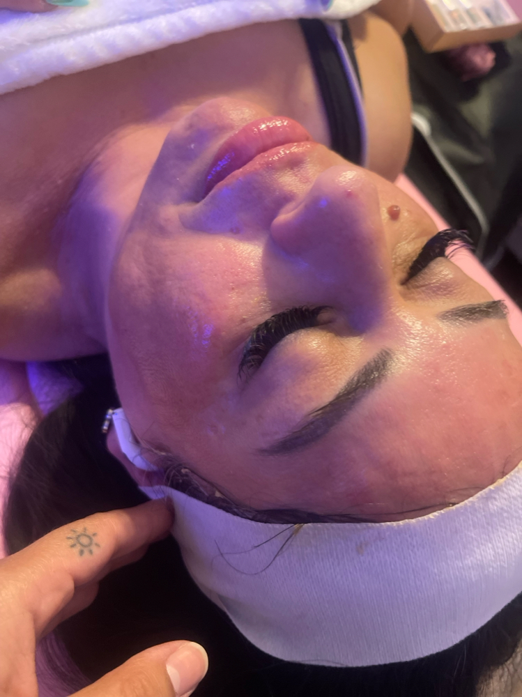 Microneedling Treatment