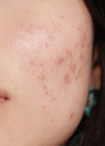 Acne Detox Facial