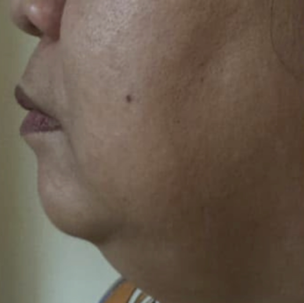 Double Chin Treatment at Derma Aesthetics by Juvy in Brea, CA