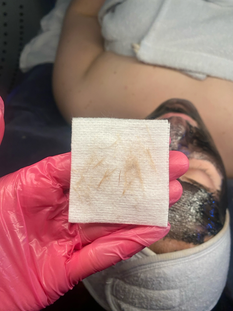 Dermaplaning at skin by gianna v in yorktown, NY