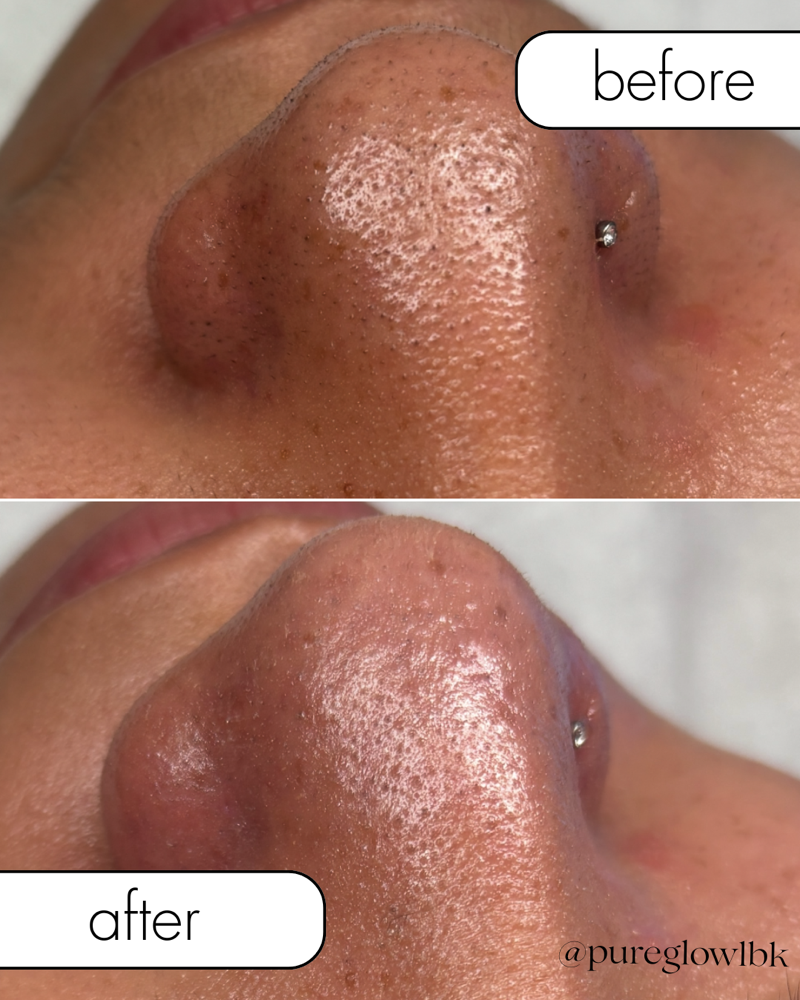 Acne/Deep Pore Cleansing Facial at Biblical Beauty LBK in Lubbock, TX