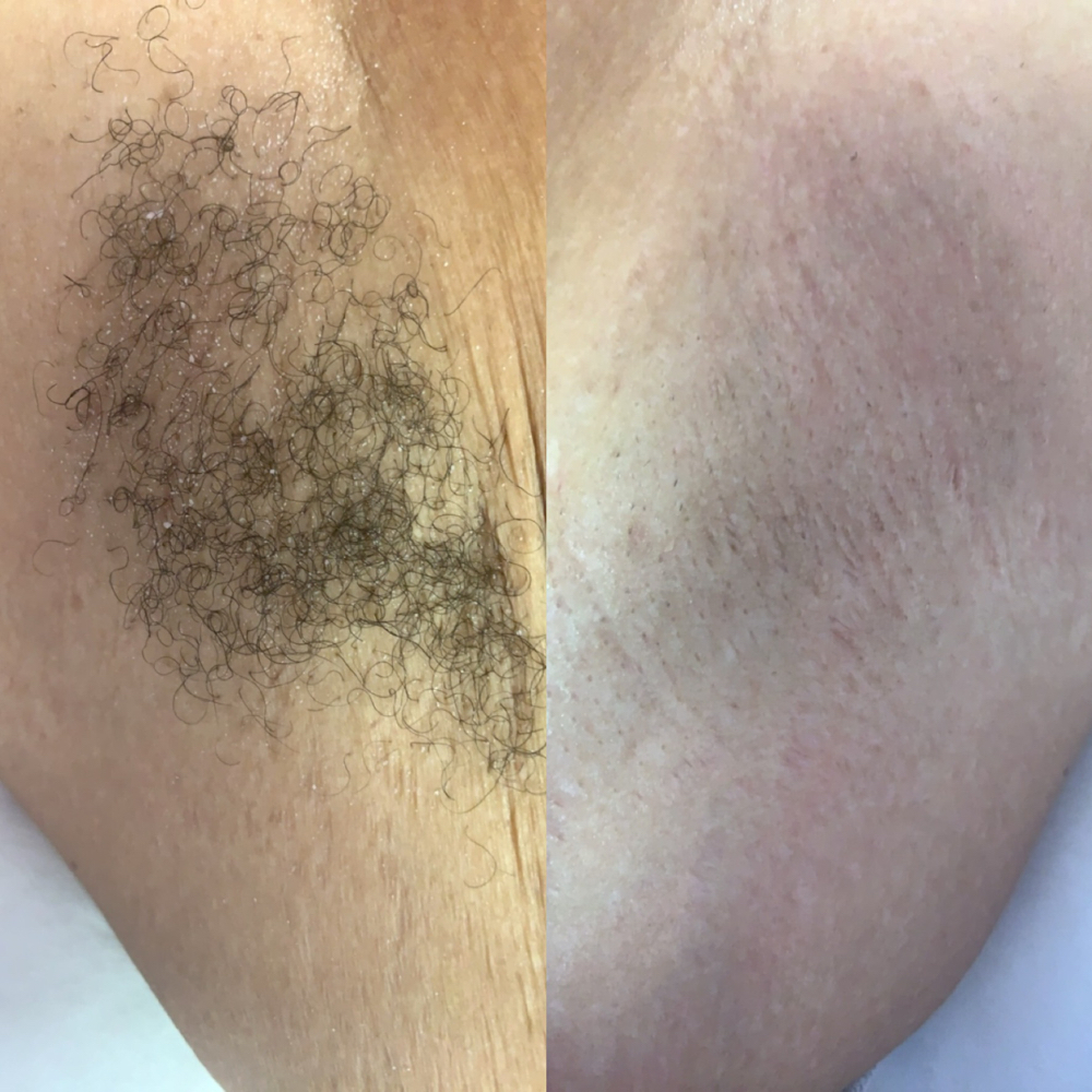 Underarm Wax