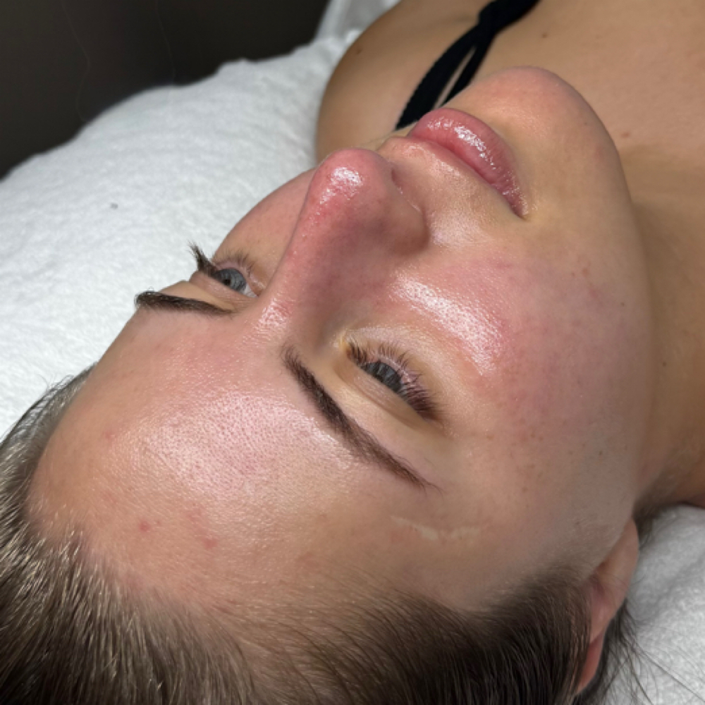 Dermaplaning Radiance Facial (with Light Peel) at Taiane Alvarenga Concept in Woburn, MA