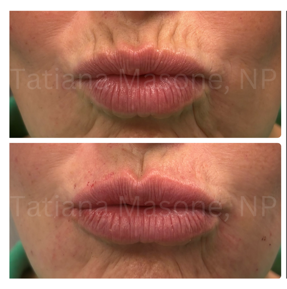 Smokers Line Filler