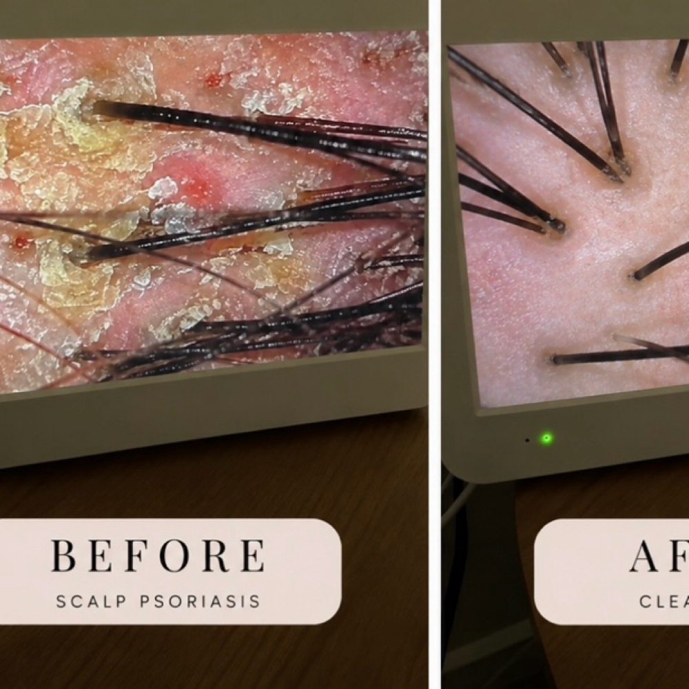 Scalp Therapy (4 Sessions) at Glam Esthetics Spa in Tampa, FL