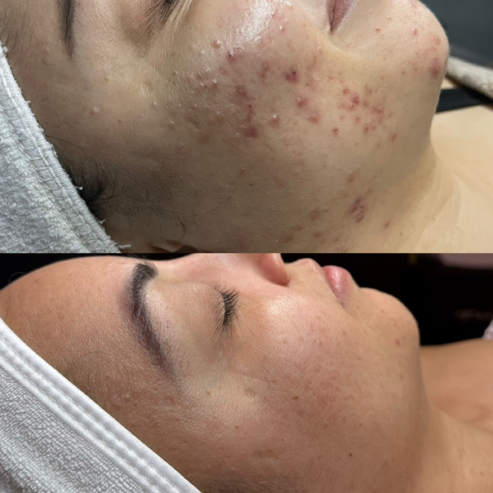 Decongesting Facial (Acne Facial) at Hanssy Esthetics in Boynton Beach, FL