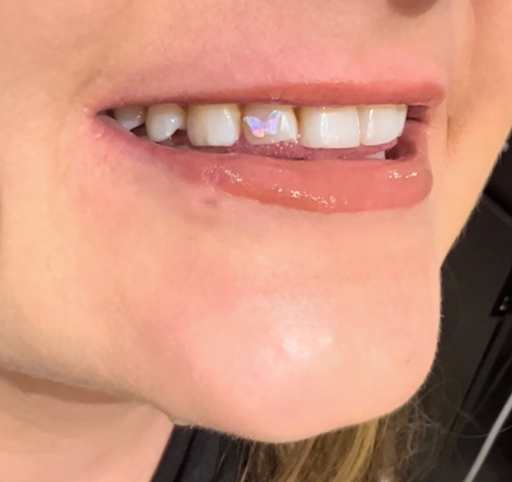 Opal Tooth Gem Shape at Lasting Impressions LHC in Lake Havasu City, AZ