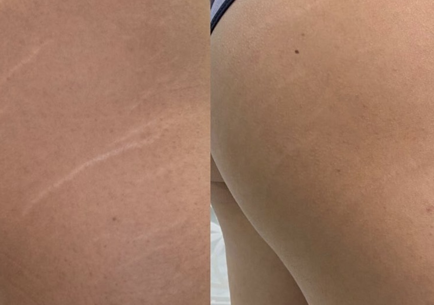 Brazilian Stretch Mark Treatments
