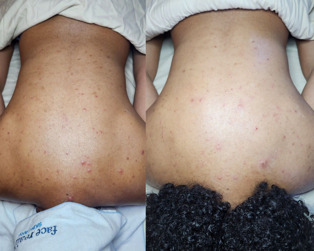 Acne Back Treatment