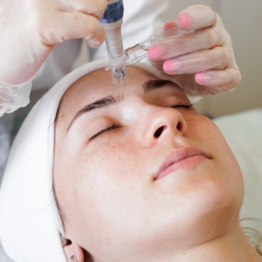 Microneedling at Enhanced Beauty Esthetics in Washington, UT