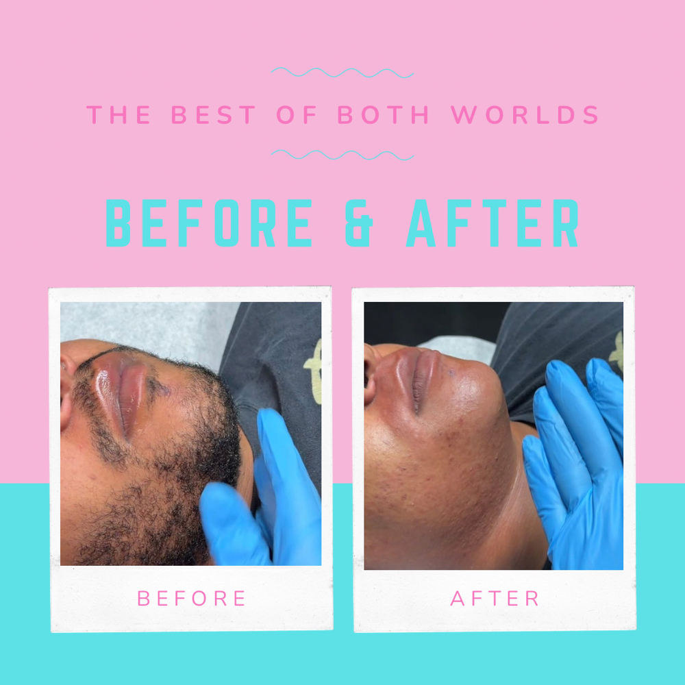 Hirsutism Facial Wax Treatment (PCO at The Best of Both Worlds Studio in Columbia, SC