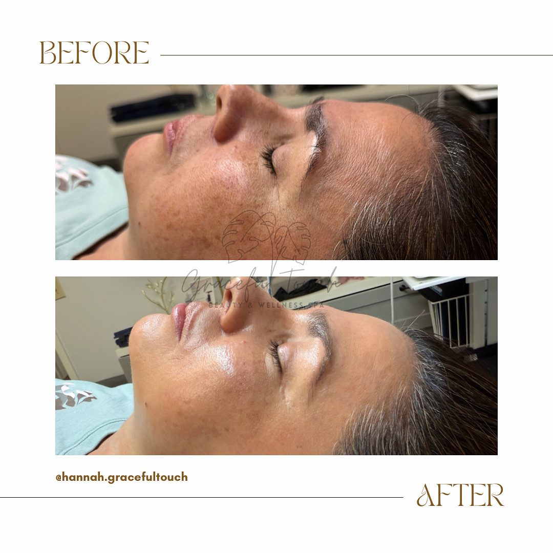 Graceful Luminous Melasma