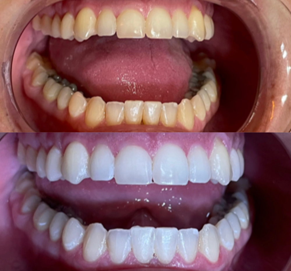 Teeth Whitening