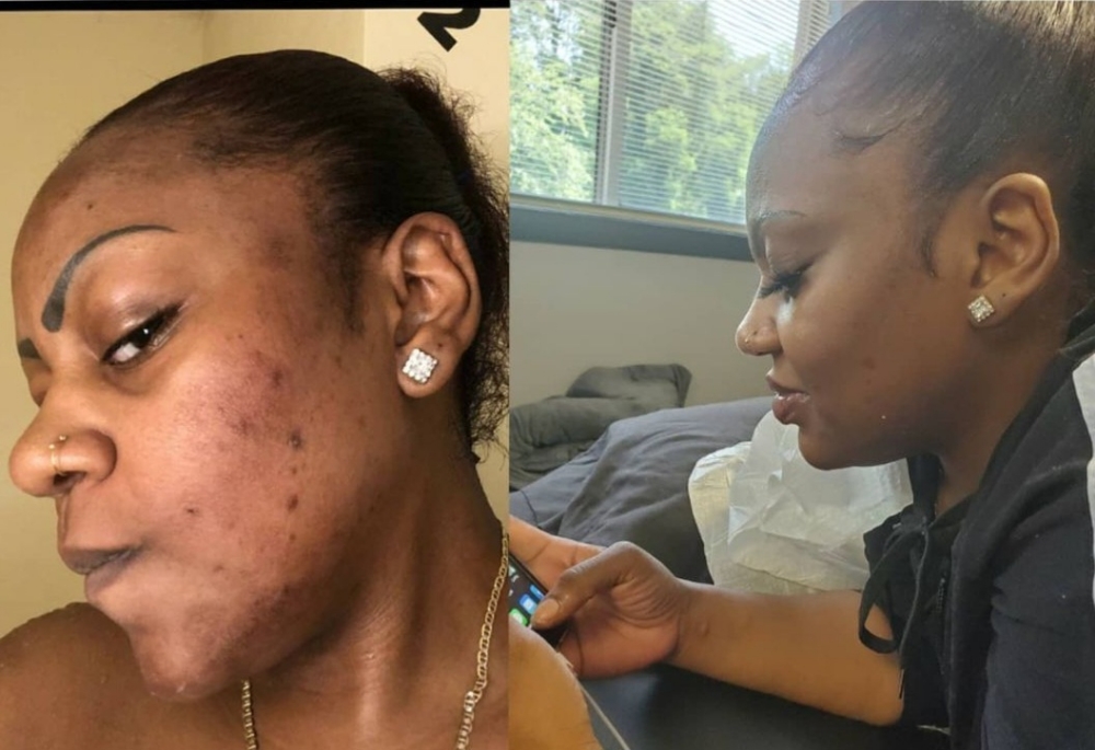 Hyperpigmentation&AcneScar