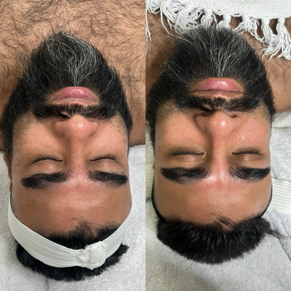 Uplifting Treatment