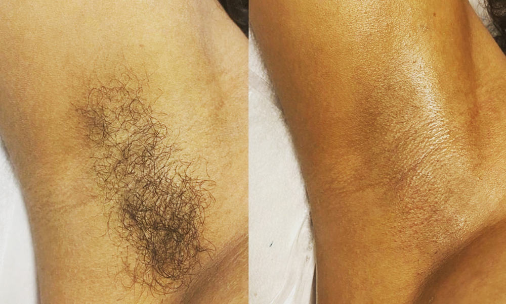 Underarms