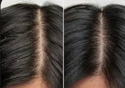 Scalp Exfoliation Treatment