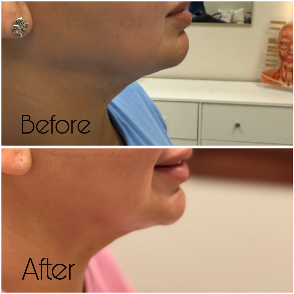 Liquid Lipo (PCDC) at Le' Spa in McAllen, TX