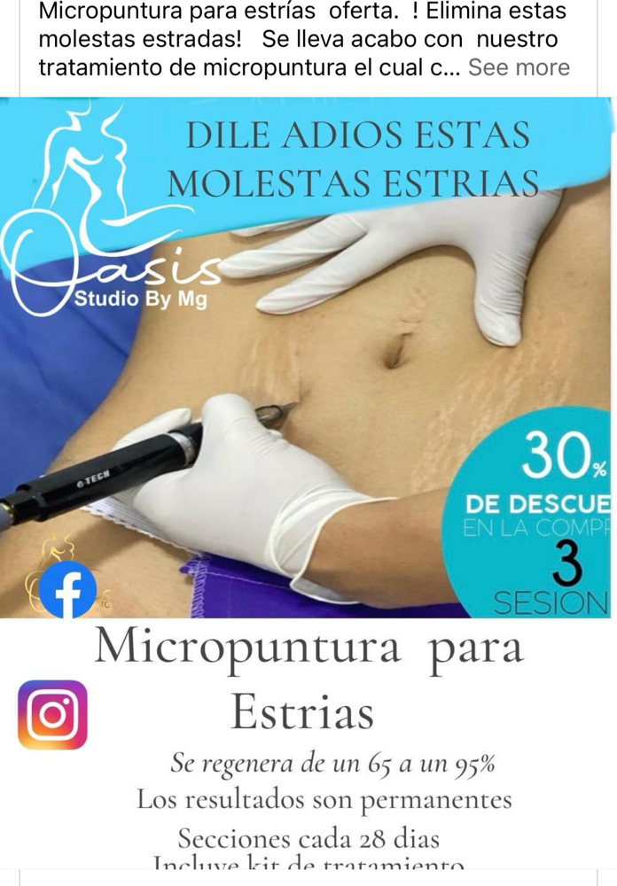 Micropuntura Estrias