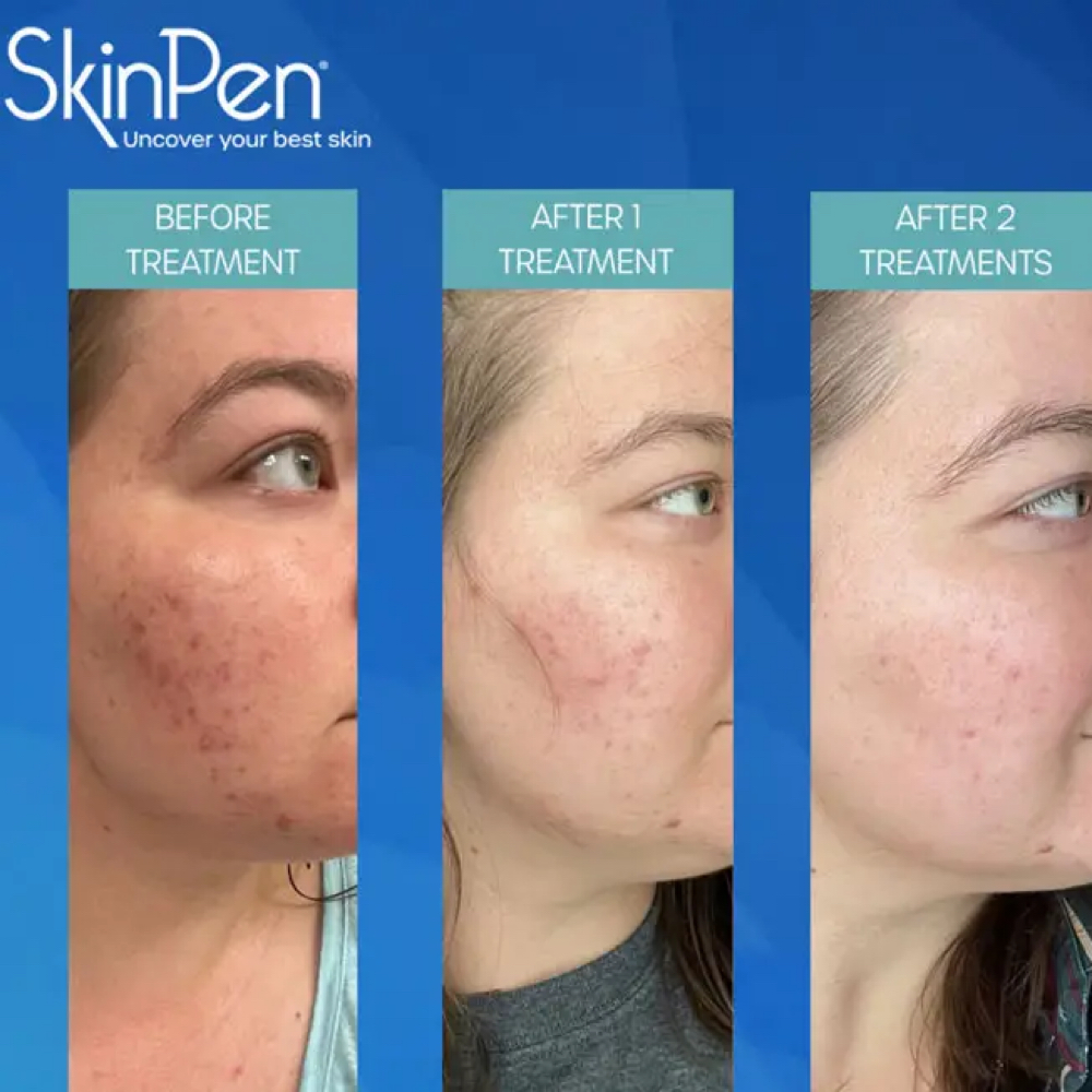 SkinPen Microneedling at Glam & Glow MedSpa in Plano, TX