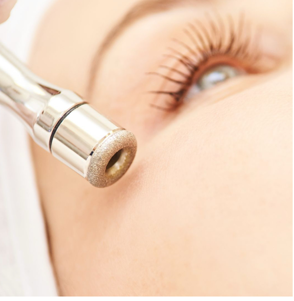MicroDermabration
