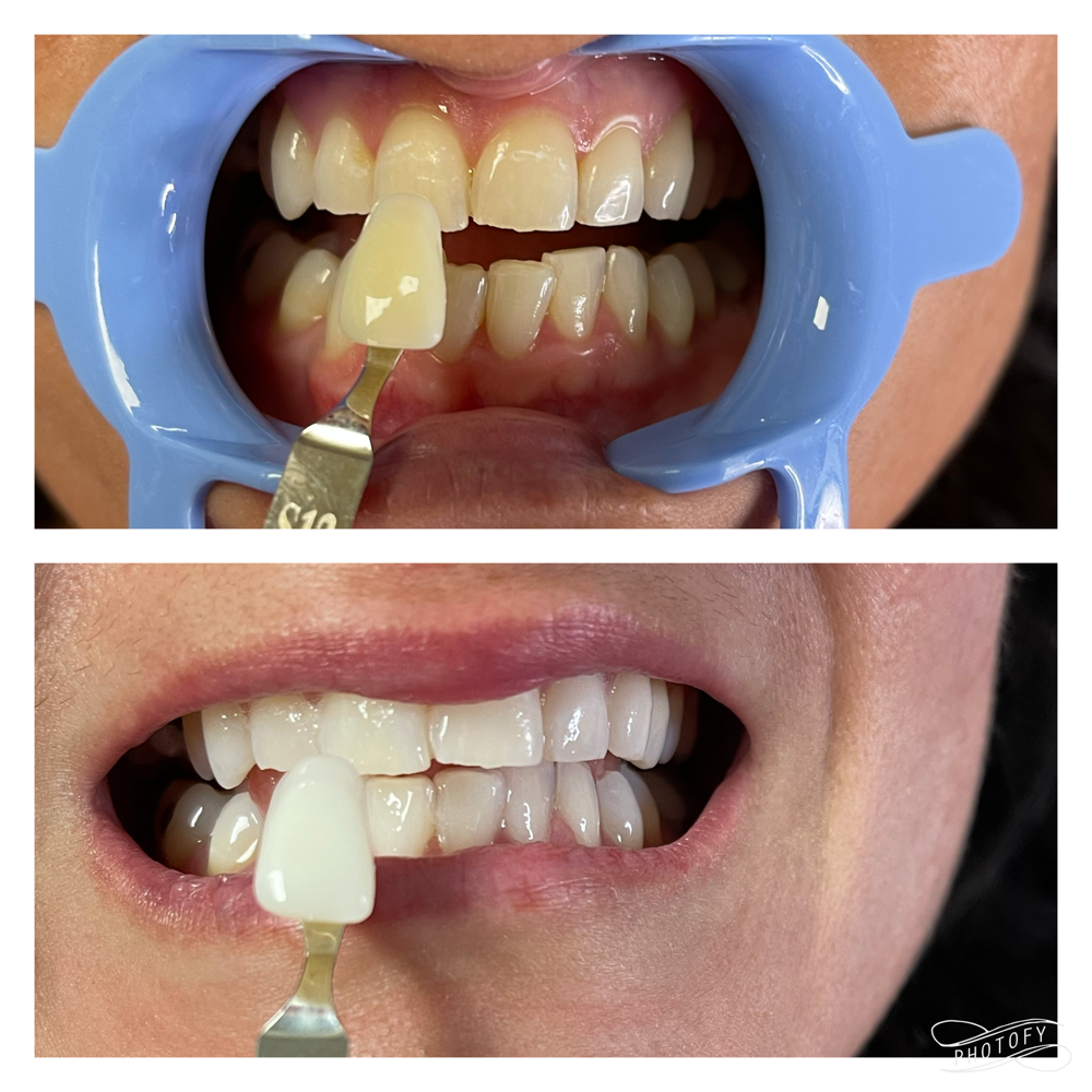 Complete Teeth Whitening Session at Ink Ice & Ivory LLC in Williston, ND