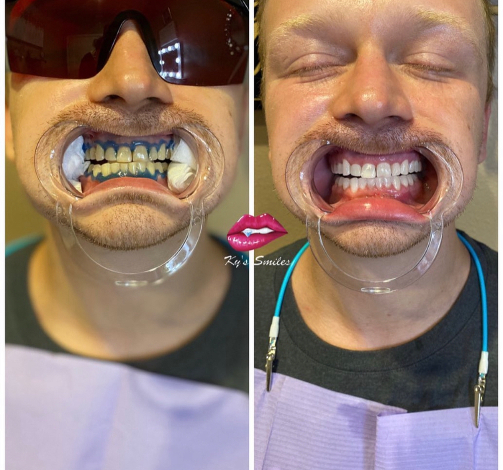 90 Minute Whitening Session