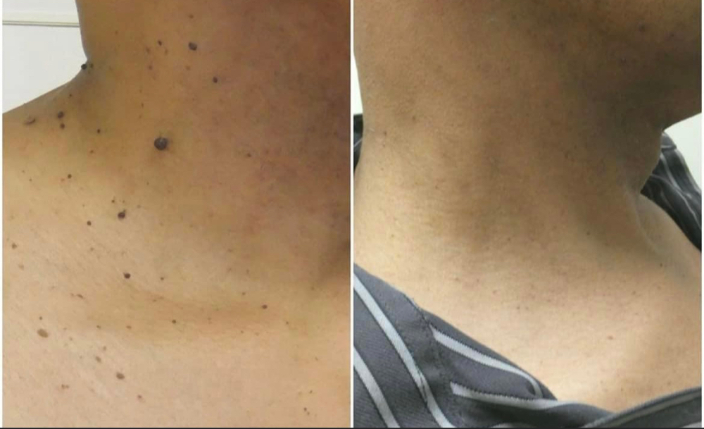 Skin Tag Removal