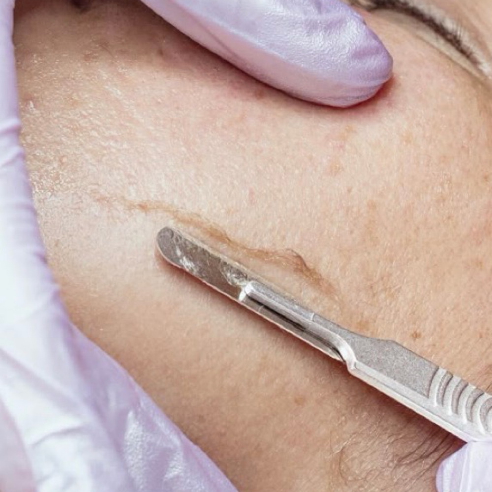 Dermaplaning Add On at TBL Aesthetics in Waterville, ME