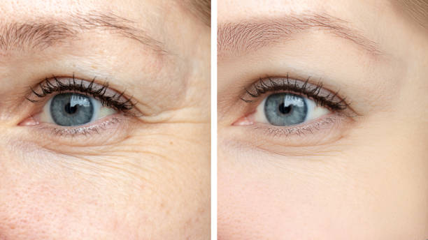 Botox per unit