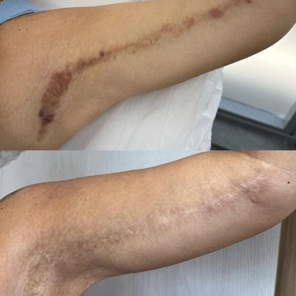 Paramedical Scar Camouflage at KC Permanent Makeup Academy & Studio in Apollo Beach, FL
